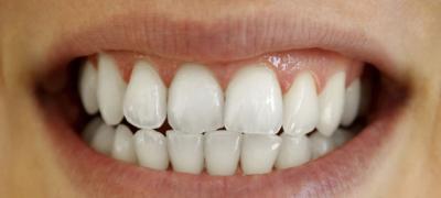 Kаkо da odstranite žute naslage na zubima pomoću jednog sastojka?