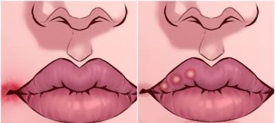 Promene na usnama koje mogu da ukazuju na neki zdravstveni problem