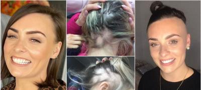 Devojka iz Irske objavila je iskrene fotografije kako izgleda alopeacija - za 5 godina izgubila je 80% kose
